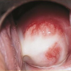 Chlamydia discharge in a vagina