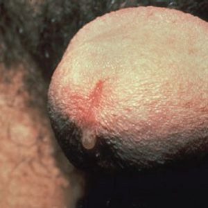 Chlamydia discharge from a penis