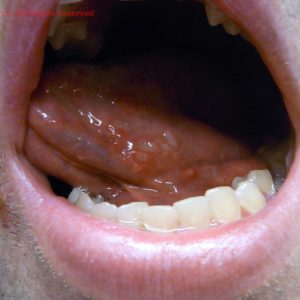 Oral sores on tongue