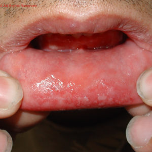 Oral sores inside lips