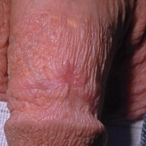 LGV ulcer on penis