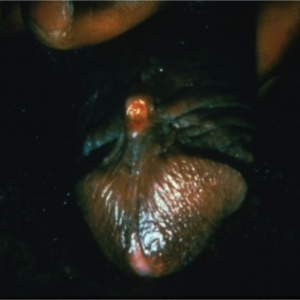 LGV ulcer on penis