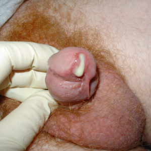 Gonorrhoea discharge from a penis