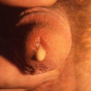 Gonorrhoea discharge from a penis