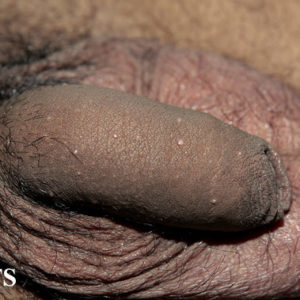 MC lesions on penis