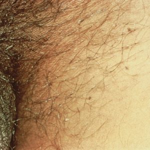 Pubic lice in pubic region