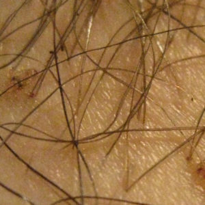 Pubic lice (close up)