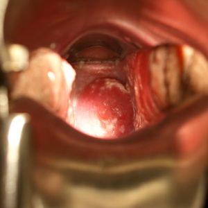 Oral thrush infection in the throat