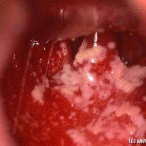 Oral thrush infection in the throat