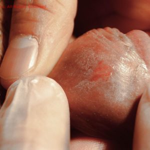 Balanoposthitis caused by candida (thrush)