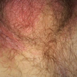 Tinea underneath testicles