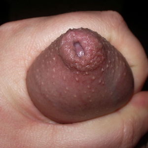 Phimosis on an erect penis (top view) also showing fordyce spots