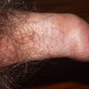 Phimosis on an erect penis (side view) also showing fordyce spots